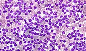 Mantle Cell Lymphoma: Everything You Want To Know